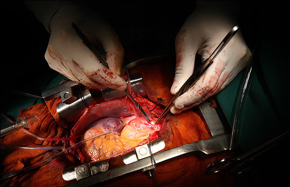 عمل جراحی قلب باز چگونه انجام می شود