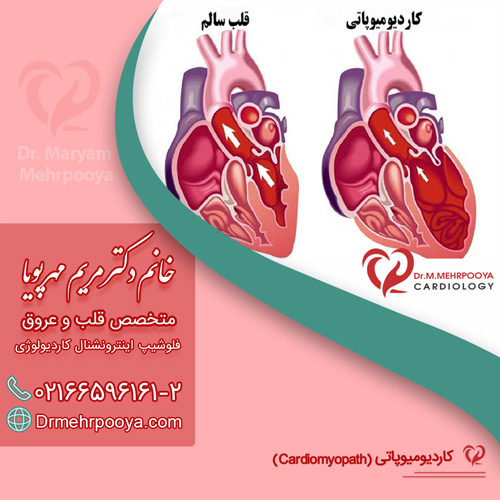 کاردیومیوپاتی یا بیماری التهابی عضله قلب
